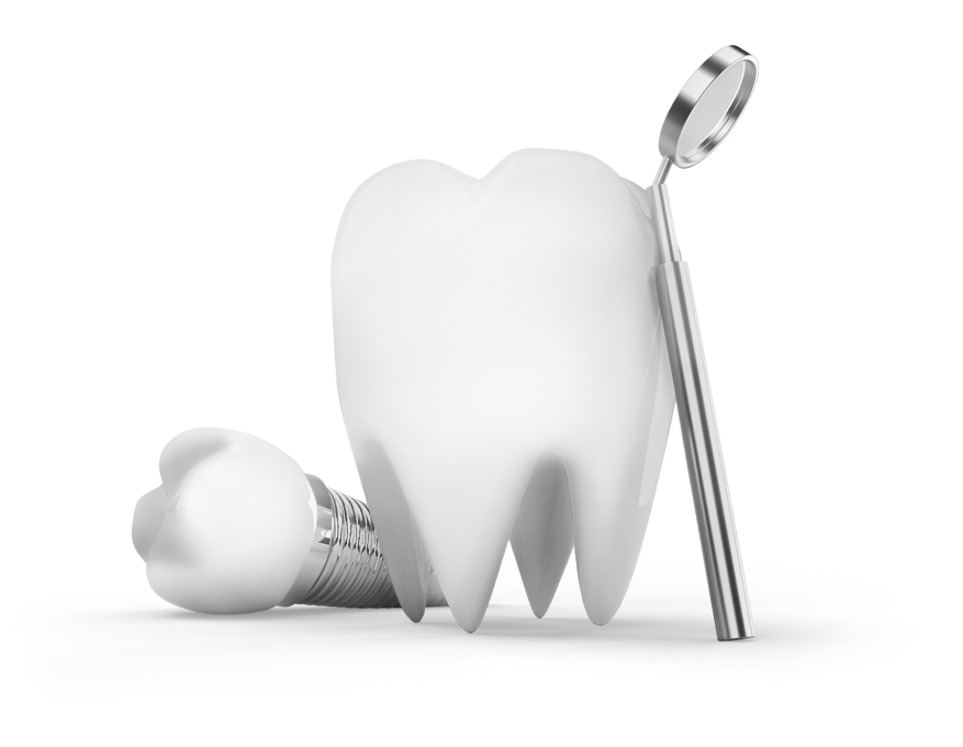 dental implants