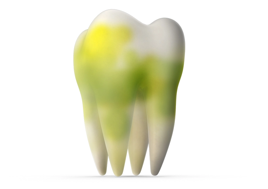 prevent-gum-disease Prevent gum disease